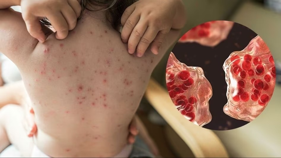 হাম হলে করণীয় কি