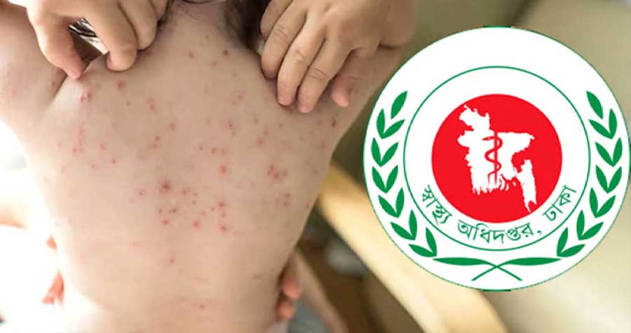 ২৪ ঘণ্টায় হাম ও হামের উপসর্গ নিয়ে ৯ জনের মৃত্যু