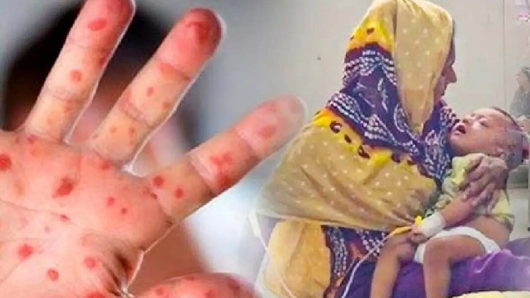 হাম ও উপসর্গে আরও ১০ শিশুর মৃত্যু