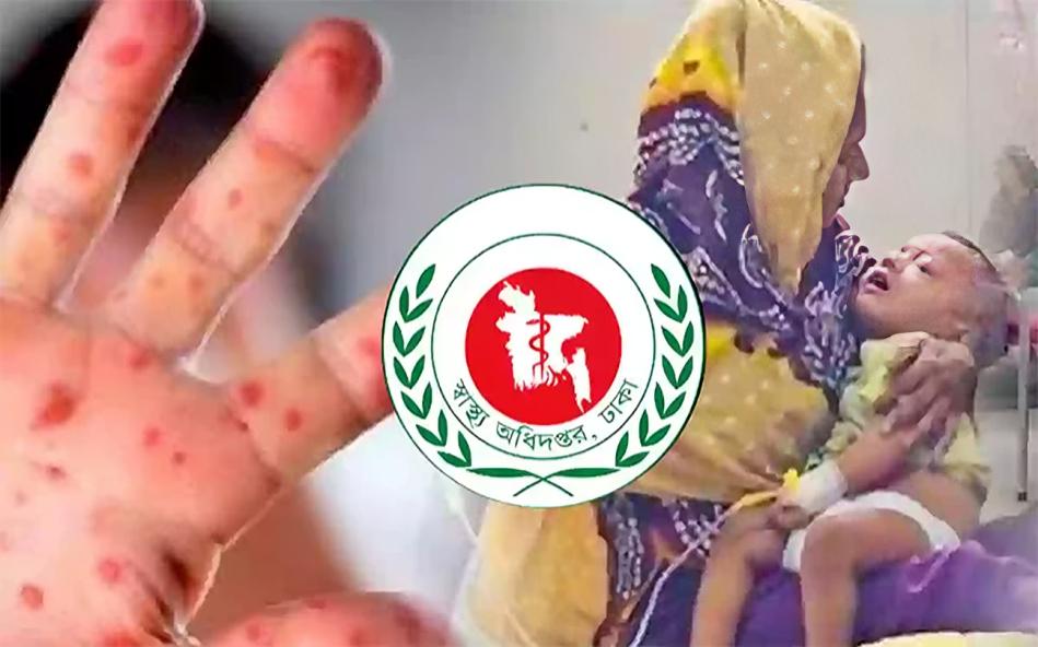 হামের উপসর্গে আরও ৩ শিশুর মৃত্যু