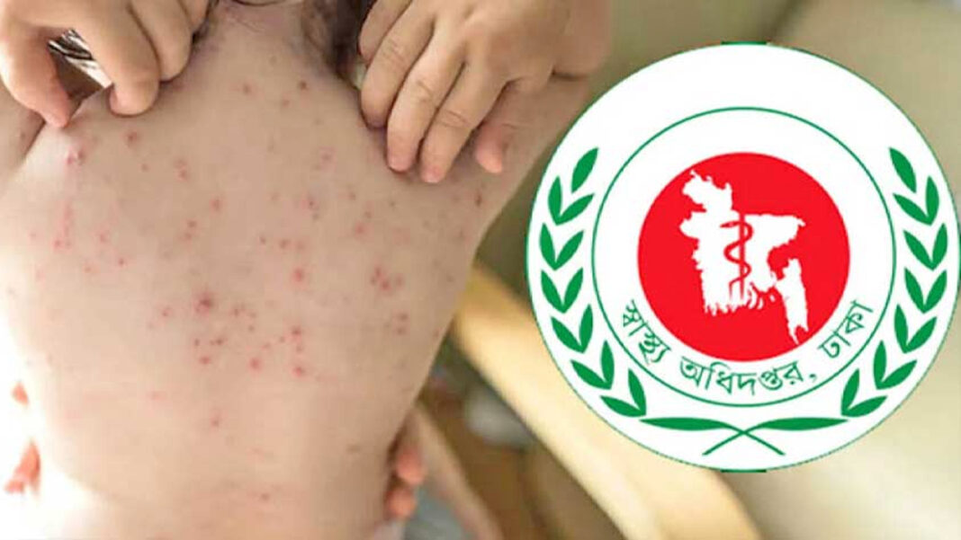 হাম উপসর্গে আরও ৬ শিশুর মৃত্যু, প্রাণহানি ছাড়াল ৮০০ হাম উপসর্গে আরও ৬ শিশুর মৃত্যু, প্রাণহানি ছাড়াল ৮০০