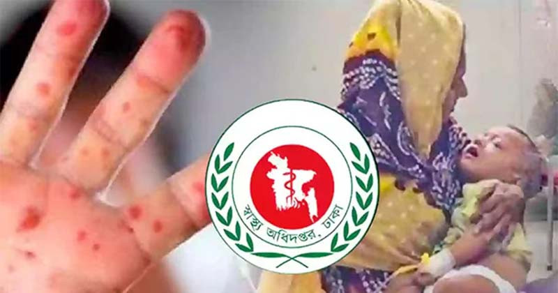 হাম উপসর্গে আরো ৫ প্রাণহানি