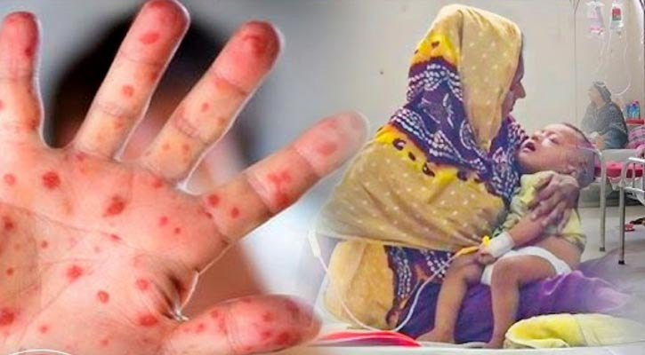 হাম উপসর্গে একদিনে ১১ জনের মৃত্যু, আক্রান্ত ১২৭০ হাম উপসর্গে একদিনে ১১ জনের মৃত্যু, আক্রান্ত ১২৭০