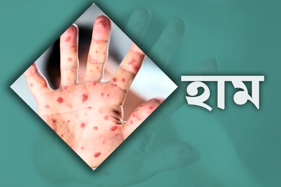 হাম উপসর্গে আরো ৪ শিশুর মৃত্যু