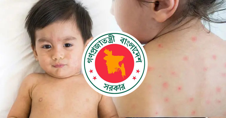 দেশে হামে মৃত্যু হাজার ছাড়ালো দেশে হামে মৃত্যু হাজার ছাড়ালো