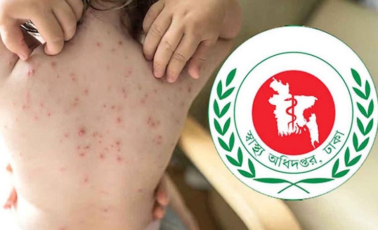 হাম উপসর্গে আরো ৮ প্রাণহানি হাম উপসর্গে আরো ৮ প্রাণহানি