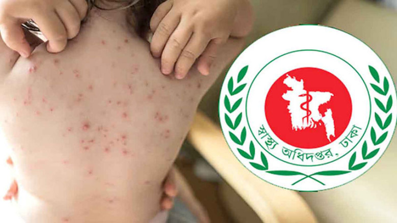 হাম উপসর্গে আরও ৪ জনের মৃত্যু, হাসপাতালে ১৩৯২