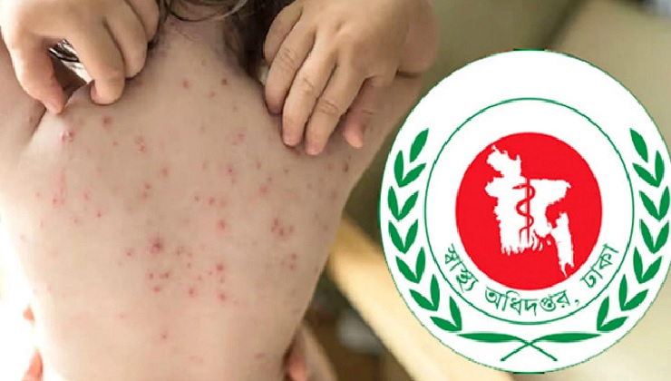 হাম উপসর্গে আরও ৩ জনের মৃত্যু, আক্রান্ত ১৩০০