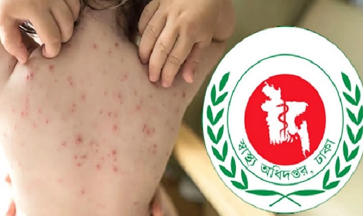 হাম উপসর্গে গত ২৪ ঘণ্টায় ৮ জনের মৃত্যু, হাসপাতালে ১০৬৫